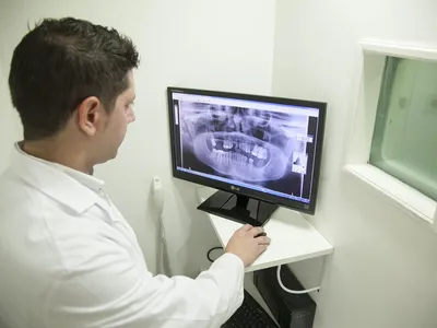 Maxillaire inférieure (mandibule) trop avancé (Classe III)